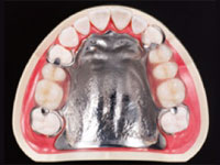 金属床義歯|かぎたに歯科医院